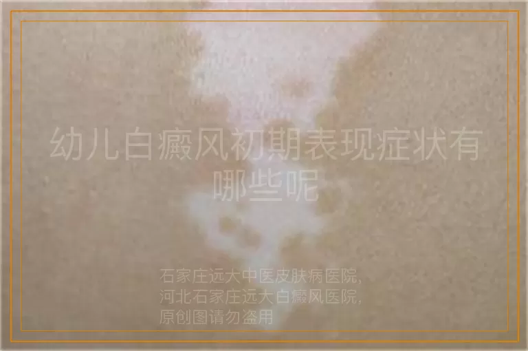 幼儿白癜风初期表现症状有哪些呢