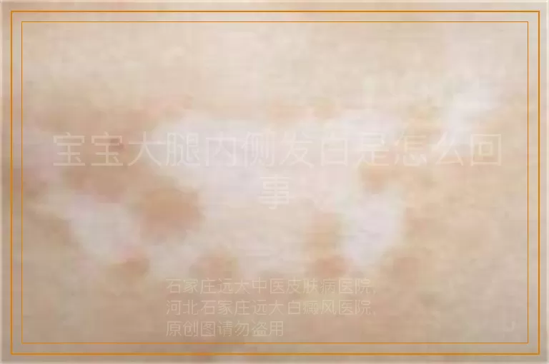 宝宝大腿内侧发白是怎么回事