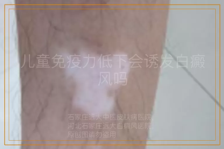 儿童免疫力低下会诱发白癜风吗