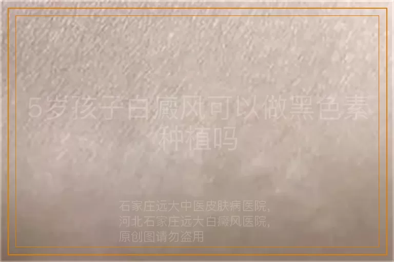 5岁孩子白癜风可以做黑色素种植吗