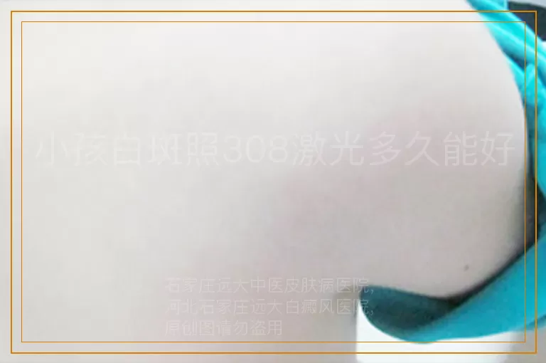 小孩白斑照308激光多久能好