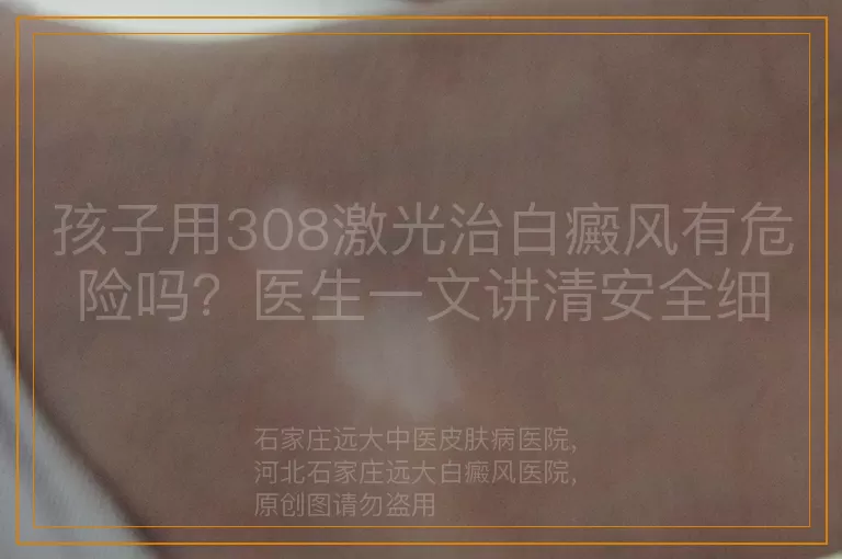 孩子用308激光治白癜风有危险吗？医生一文讲清安全细节
