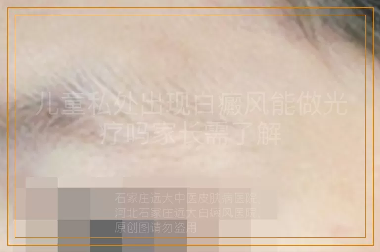 儿童私处出现白癜风能做光疗吗家长需了解