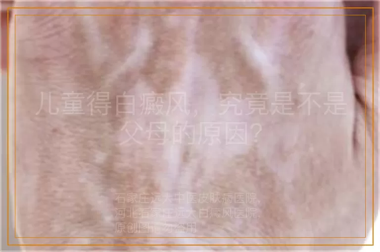 儿童得白癜风，究竟是不是父母的原因？