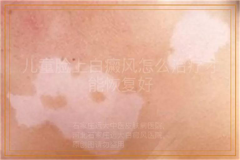 儿童脸上白癜风怎么治疗才能恢复好