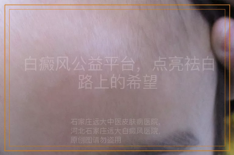 白癜风公益平台，点亮祛白路上的希望