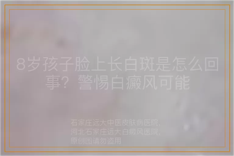 8岁孩子脸上长白斑是怎么回事？警惕白癜风可能
