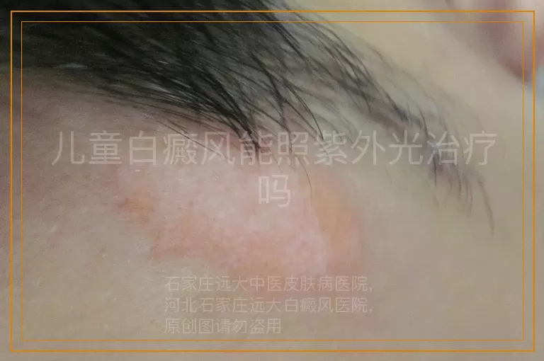 儿童白癜风能照紫外光治疗吗
