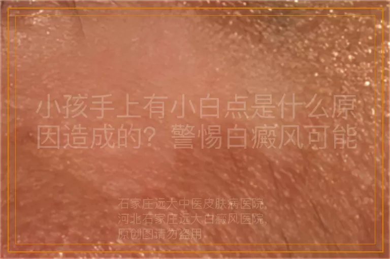 小孩手上有小白点是什么原因造成的？警惕白癜风可能