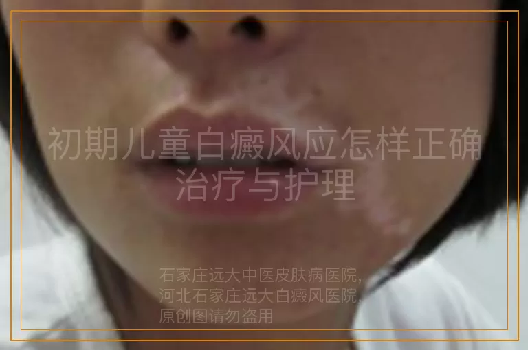 初期儿童白癜风应怎样正确治疗与护理