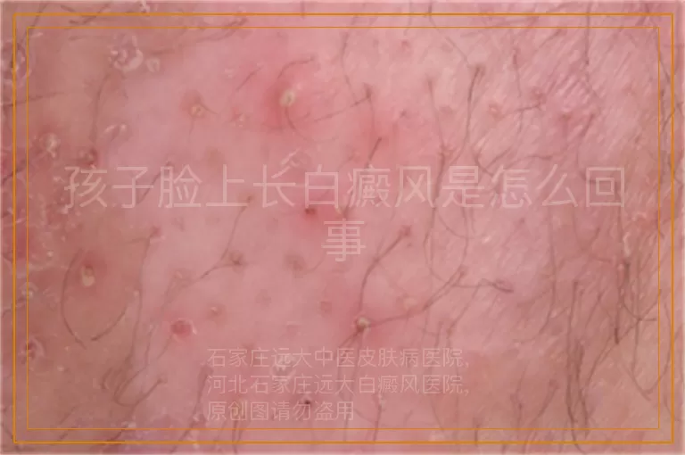 孩子脸上长白癜风是怎么回事