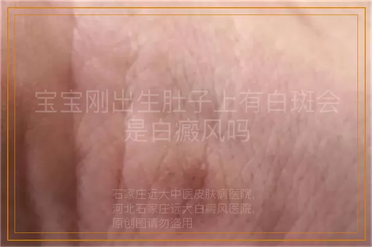 宝宝刚出生肚子上有白斑会是白癜风吗