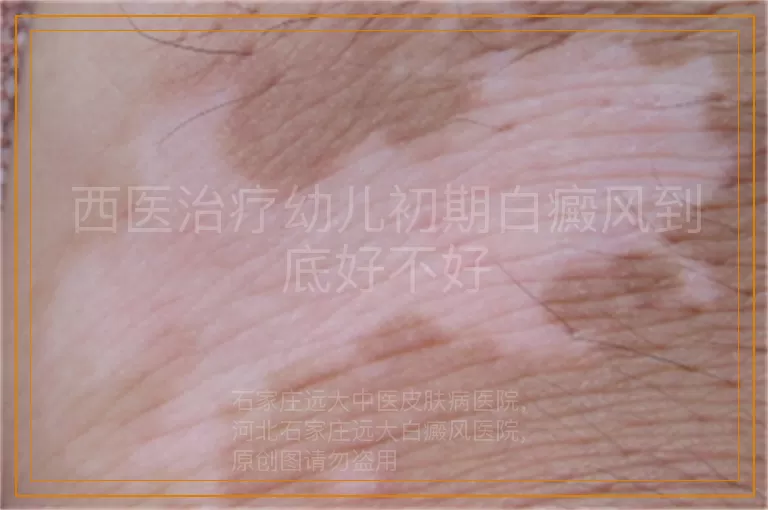 西医治疗幼儿初期白癜风到底好不好