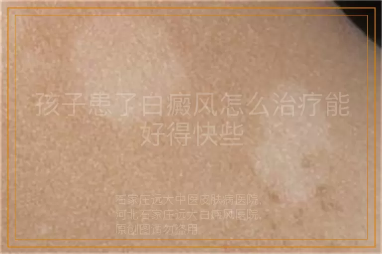 孩子患了白癜风怎么治疗能好得快些