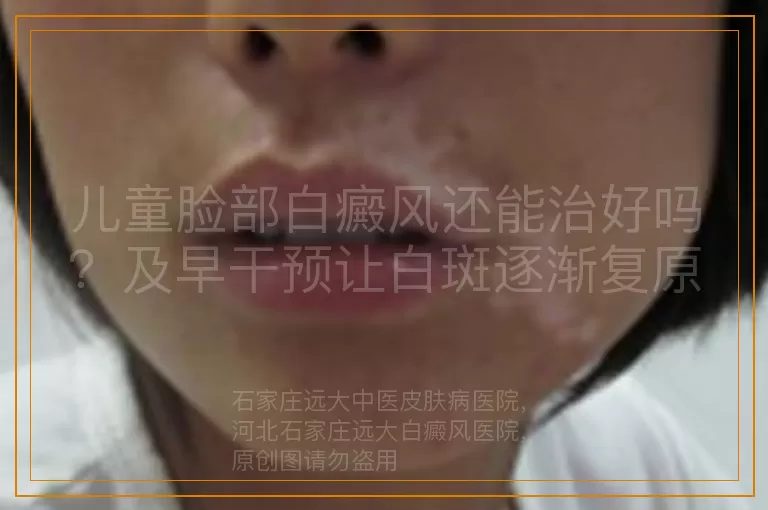 儿童脸部白癜风还能治好吗？及早干预让白斑逐渐复原