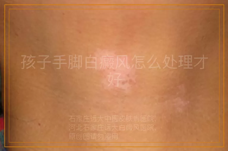 孩子手脚白癜风怎么处理才好