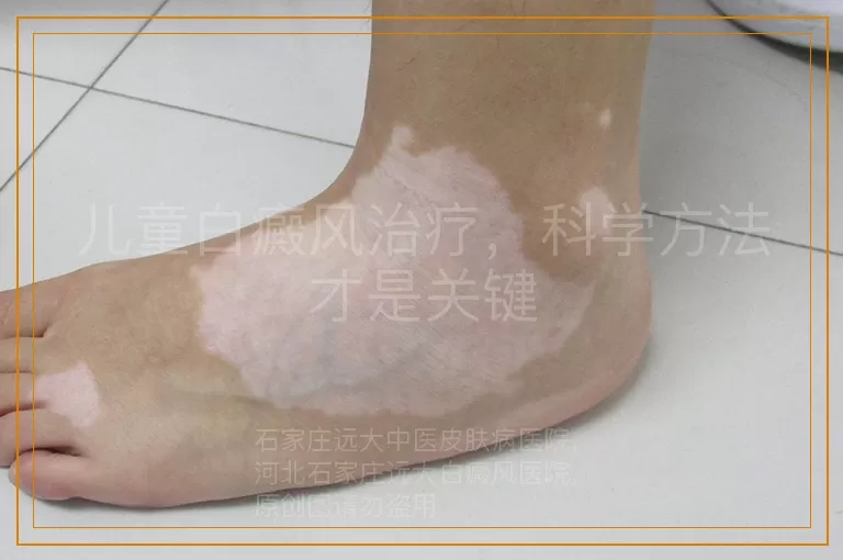儿童白癜风治疗，科学方法才是关键