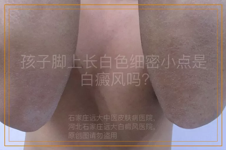 孩子脚上长白色细密小点是白癜风吗？