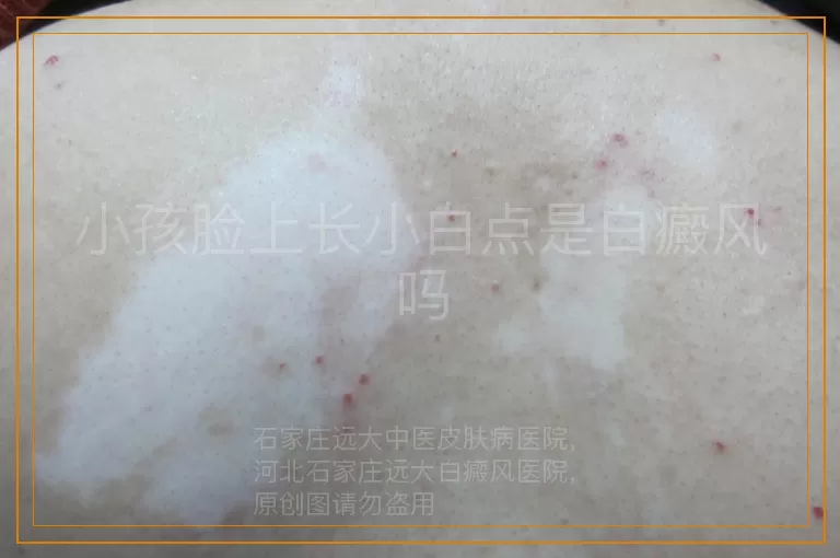 小孩脸上长小白点是白癜风吗
