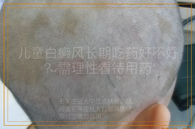 儿童白癜风长期吃药好不好？需理性看待用药