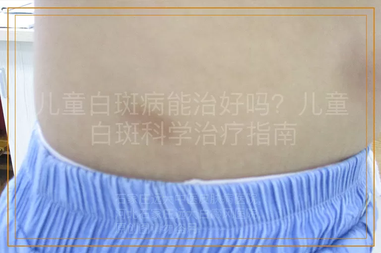 儿童白斑病能治好吗？儿童白斑科学治疗指南