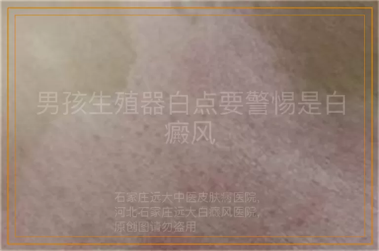 男孩生殖器白点要警惕是白癜风