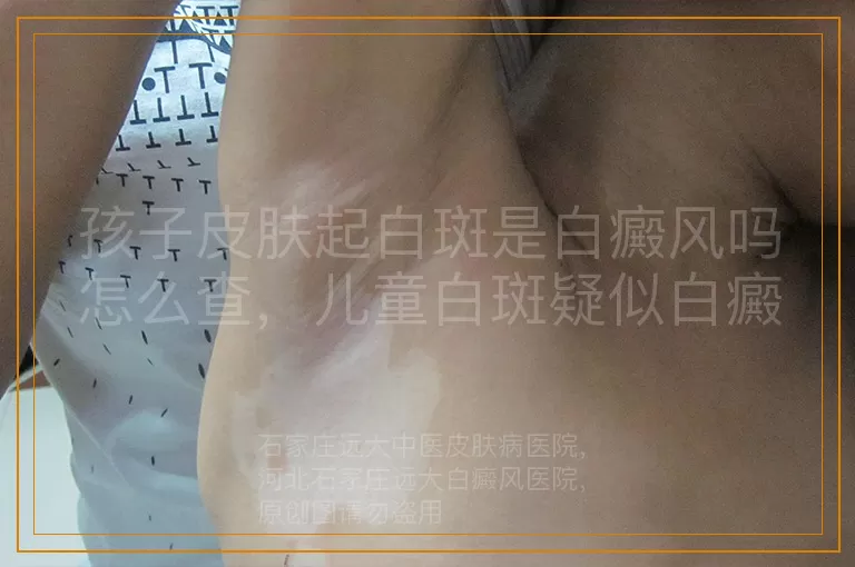 孩子皮肤起白斑是白癜风吗怎么查，儿童白斑疑似白癜风要做什么检查，小孩子长白斑怀疑白癜风如何确诊
