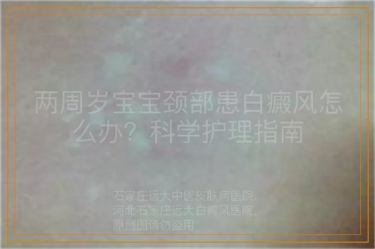 两周岁宝宝颈部患白癜风怎么办？科学护理指南