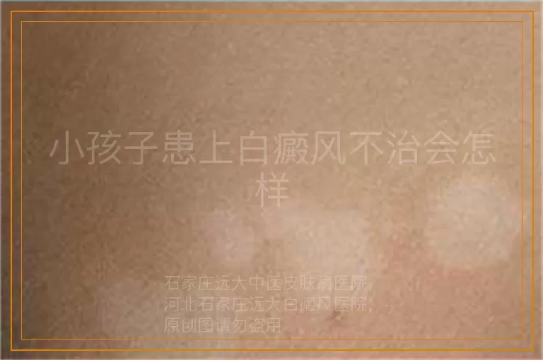 小孩子患上白癜风不治会怎样