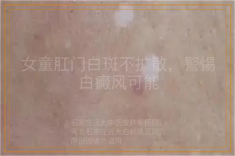 女童肛门白斑不扩散，警惕白癜风可能