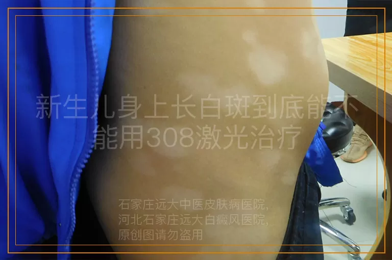 新生儿身上长白斑到底能不能用308激光治疗