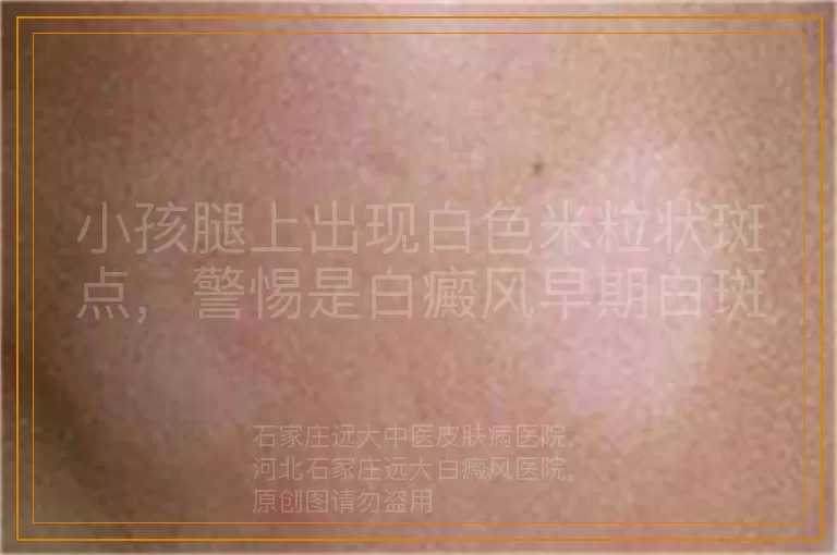 小孩腿上出现白色米粒状斑点，警惕是白癜风早期白斑