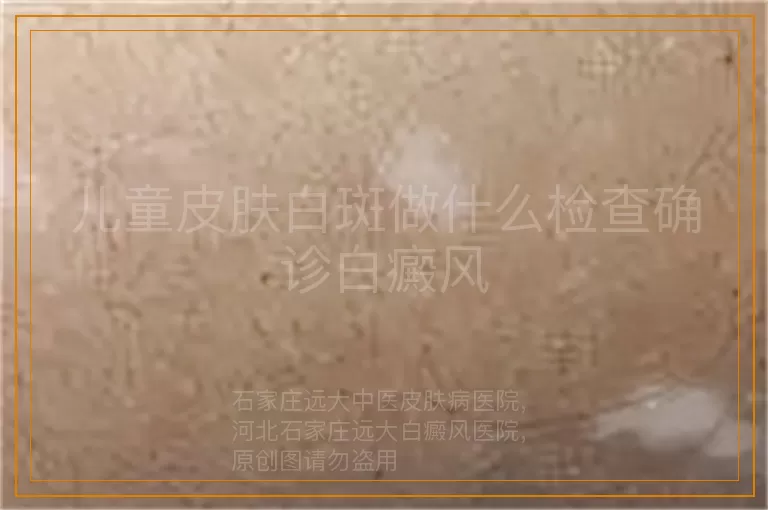 儿童皮肤白斑做什么检查确诊白癜风