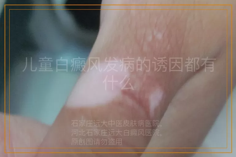 儿童白癜风发病的诱因都有什么