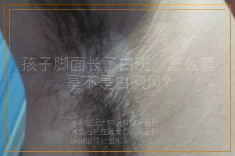 孩子脚面长了白斑，怎么看是不是白癜风？