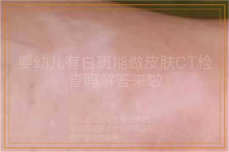 婴幼儿有白斑能做皮肤CT检查吗解答来啦