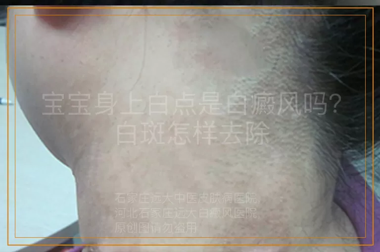 宝宝身上白点是白癜风吗？白斑怎样去除