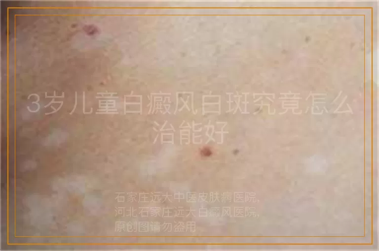 3岁儿童白癜风白斑究竟怎么治能好
