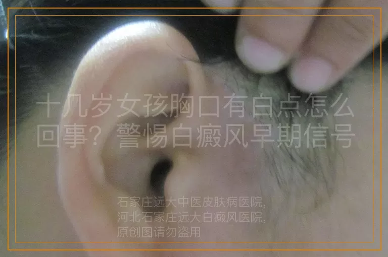 十几岁女孩胸口有白点怎么回事？警惕白癜风早期信号