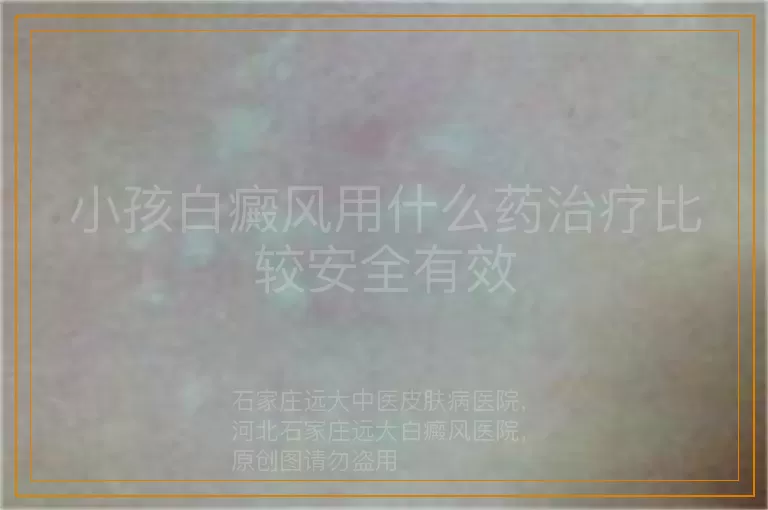 小孩白癜风用什么药治疗比较安全有效