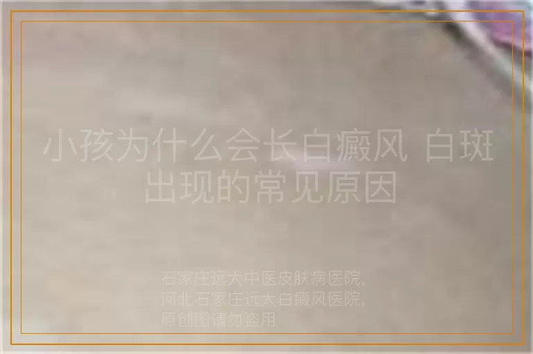 小孩为什么会长白癜风 白斑出现的常见原因