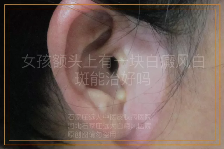 女孩额头上有一块白癜风白斑能治好吗