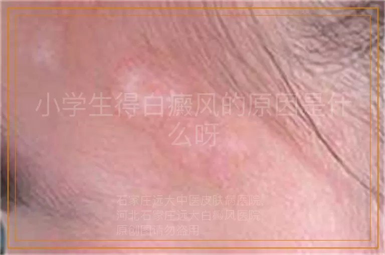 小学生得白癜风的原因是什么呀