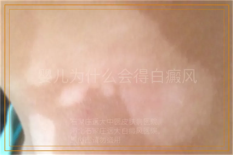 婴儿为什么会得白癜风