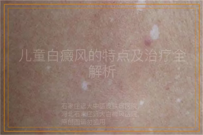 儿童白癜风的特点及治疗全解析