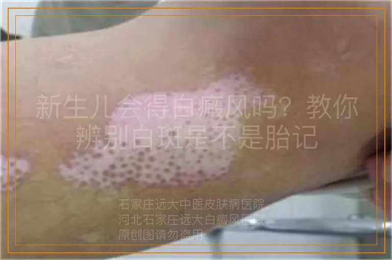 新生儿会得白癜风吗？教你辨别白斑是不是胎记