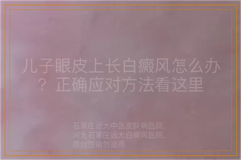 儿子眼皮上长白癜风怎么办？正确应对方法看这里