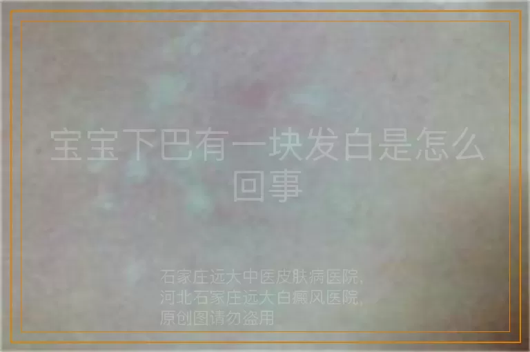宝宝下巴有一块发白是怎么回事