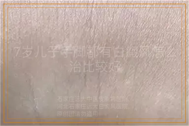 7岁儿子手脚都有白癜风怎么治比较好