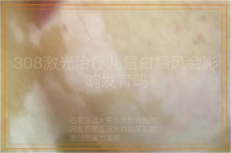308激光治疗儿童白癜风会影响发育吗
